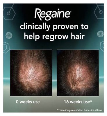 Regaine for Men Extra Strength Scalp Foam 5% w/w Cutaneous Foam - 1 months supply (6)