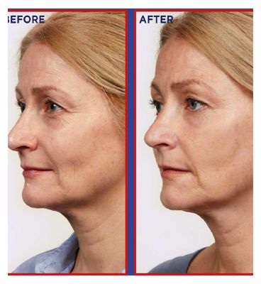 L'Oreal Paris Revitalift Laser Pure Retinol Night Serum, Anti-Wrinkle, Anti-Fine line, 30ml (5)