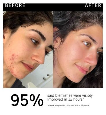 The INKEY List™ Succinic Acid Treatment 15ml (5)