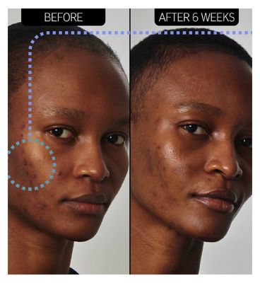 The INKEY List™ SuperSolutions 20% Niacinamide Serum 30ml (3)