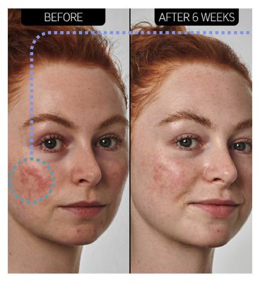 The INKEY List™ SuperSolutions 10% Azelaic Acid Serum 30ml (6)