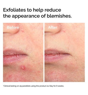 The Ordinary Salicylic Acid 2% Solution 30ml (3)