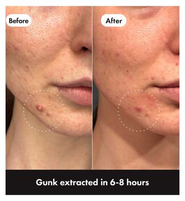 Hero Mighty Patch Invisible Spot Patches, 24 Hydrocolloid Pimple Patches (6)