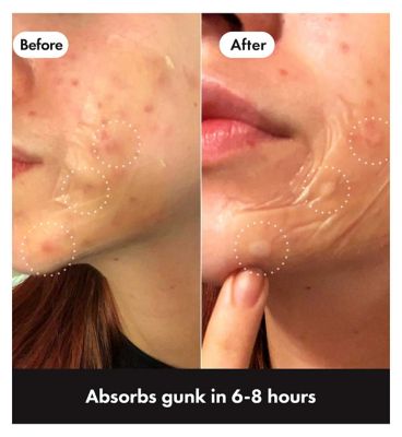 Hero Mighty Patch Surface Spot Patches, 10 Hydrocolloid Acne Patches (5)