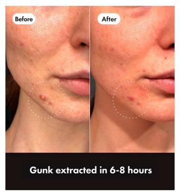 Hero Mighty Patch Duo Spot Patches, 6x Day & 6x Night Hydrocolloid Patches (3)