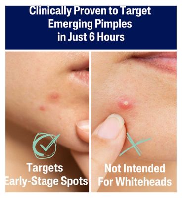 Cetaphil Gentle Clear Pimple Patches, 6 Hour Fast Clear with Salicylic Acid for Blemish-Prone Skin, 24 Emerging Spot Patches (4)