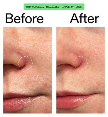 The INKEY List Jumbo Hydrocolloid Invisible Pimple Patches 44s (7)