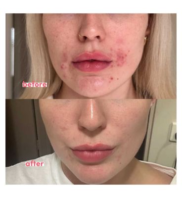 The Breakout Hack Spot Cream 30Ml (4)